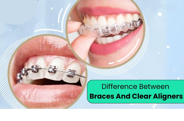 What’s the Difference Between Braces and Clear Aligners?