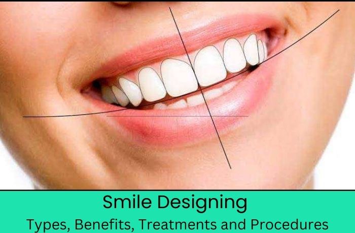 Smile Designing – Types, Benefits, Treatments, and Procedures