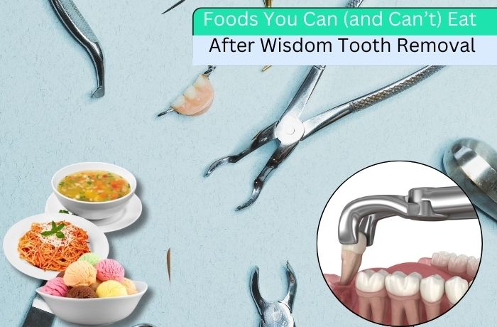 Foods You Can (and Can’t) Eat After Wisdom Tooth Removal