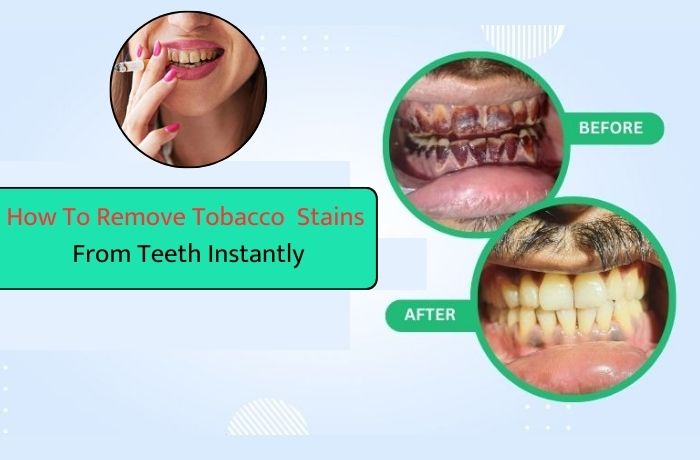 How to Remove Tobacco Stains from Teeth Instantly: Best Remedies and Tips