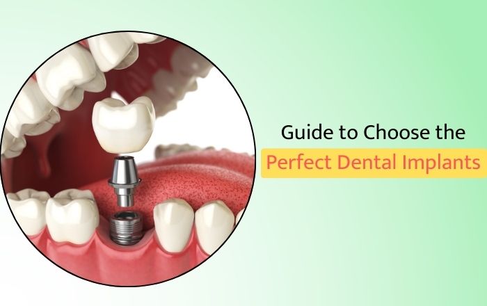 Guide to Choose the Perfect Dental Implants