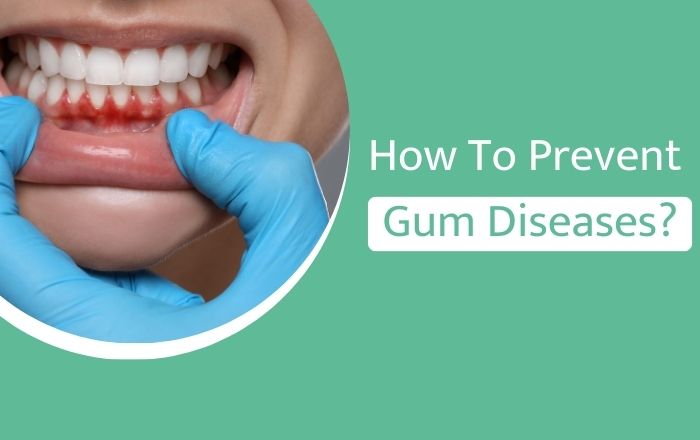 How To Prevent Gum Diseases?