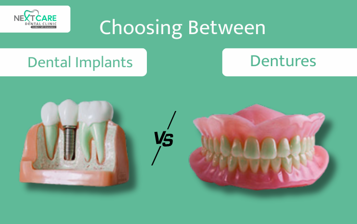 Dental Implants vs. Dentures: How to Choose the Right Option for You