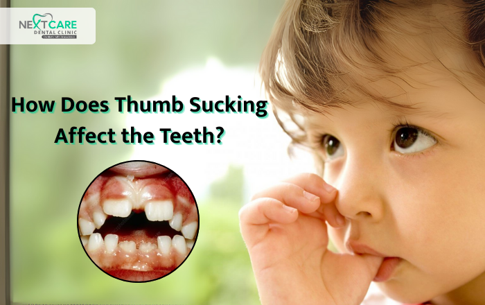 How Does Thumb Sucking Affect the Teeth?