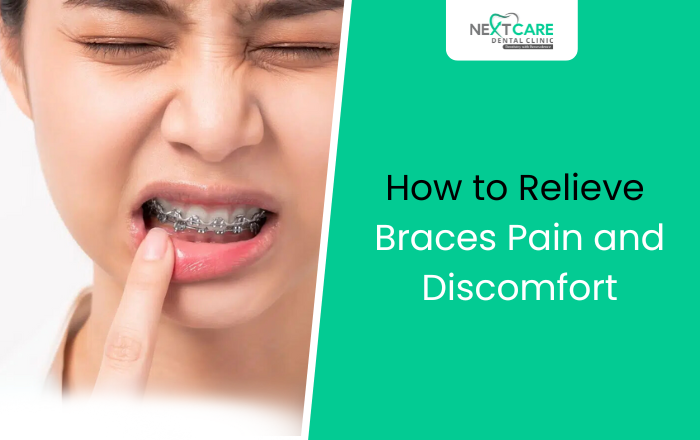 How to Relieve Pain and Discomfort After Getting Braces