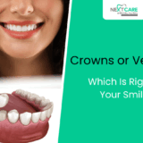 Crowns or Veneers – What's the Best Cosmetic Dental Solution?