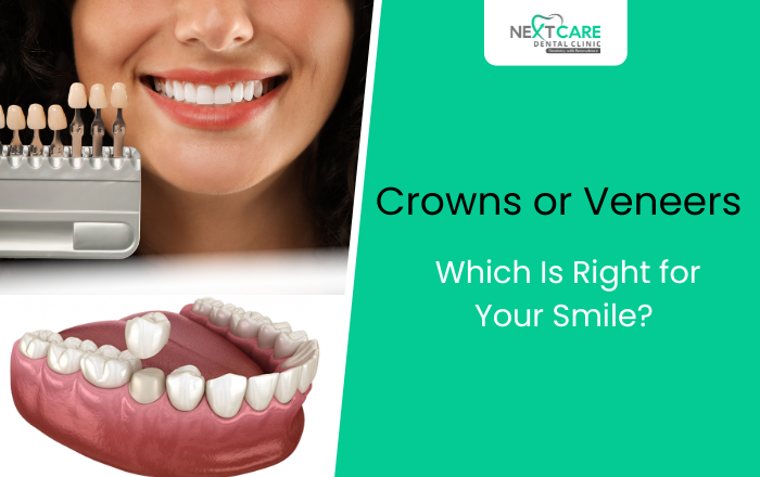 Crowns or Veneers – What’s the Best Cosmetic Dental Solution?