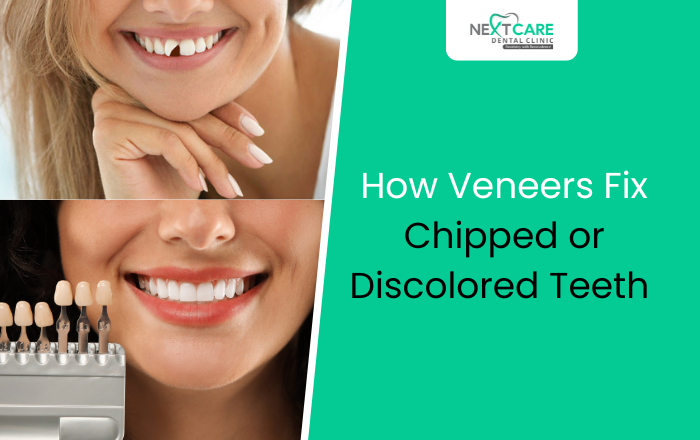 How Can Veneers Help Fix Chipped or Discolored Teeth? Your Complete Guide