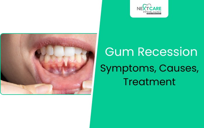 Gum Recession – Symptoms, Causes, Treatment