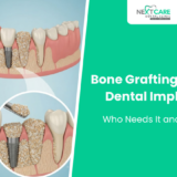 Bone Grafting Before Dental Implants: Who Needs It and Why?