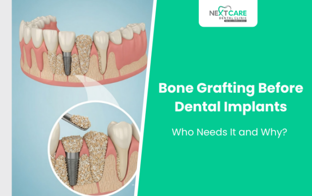Bone Grafting Before Dental Implants: Who Needs It and Why?